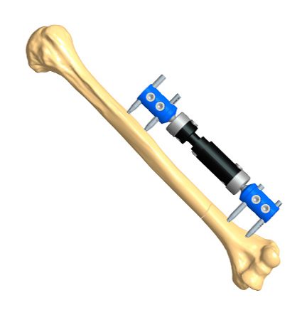 Pediatric Humerus Fracture Treatments Orthofix Abs