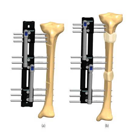 Tibia Lengthening Treatment Orthofix Abs