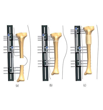 Major Tibial Soft Tissue Defects Orthofix Abs