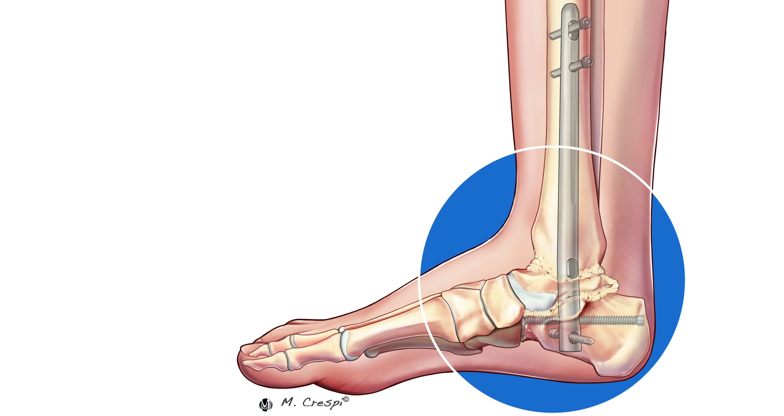 Surgical Management Of The Charcot Ankle Orthofix