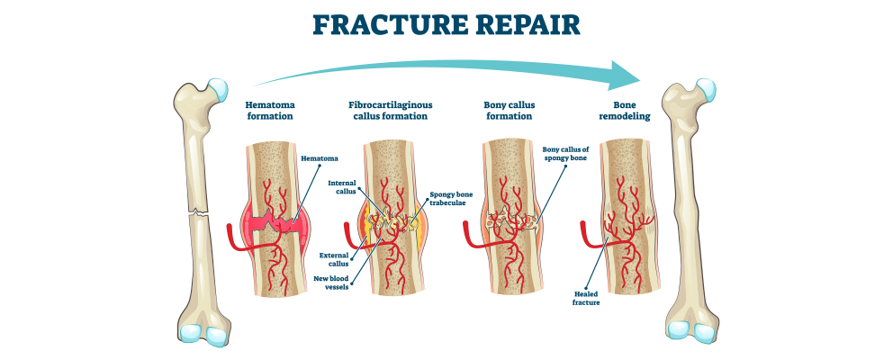, Bone Healing and The Role of External Fixation
