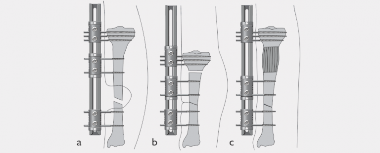 The Bone Transport Technique - Orthofix