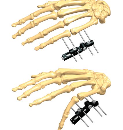 Stiff joints in hands treatments | Orthofix ABS