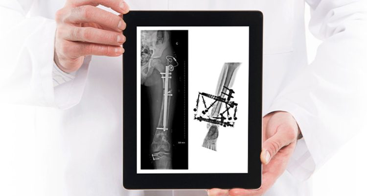 , Internal Fixation vs External Fixation