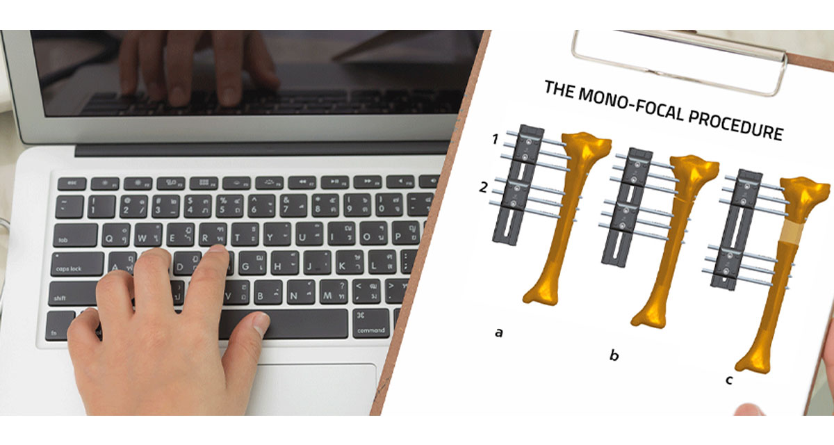 , The Monofocal Procedure with the Limb Reconstruction System (LRS)