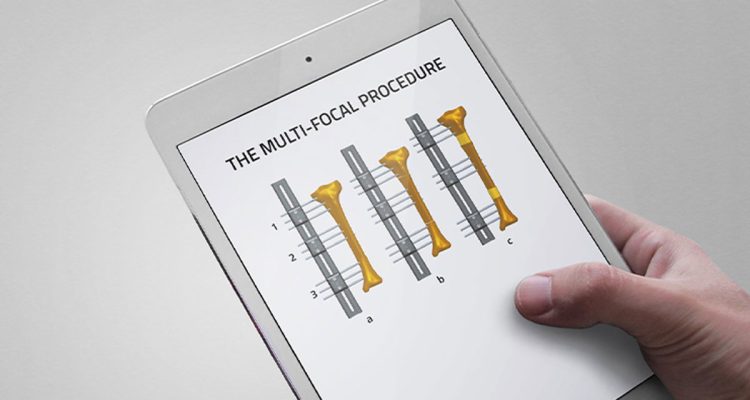 , The Multifocal Procedure with the Limb Reconstruction System (LRS)