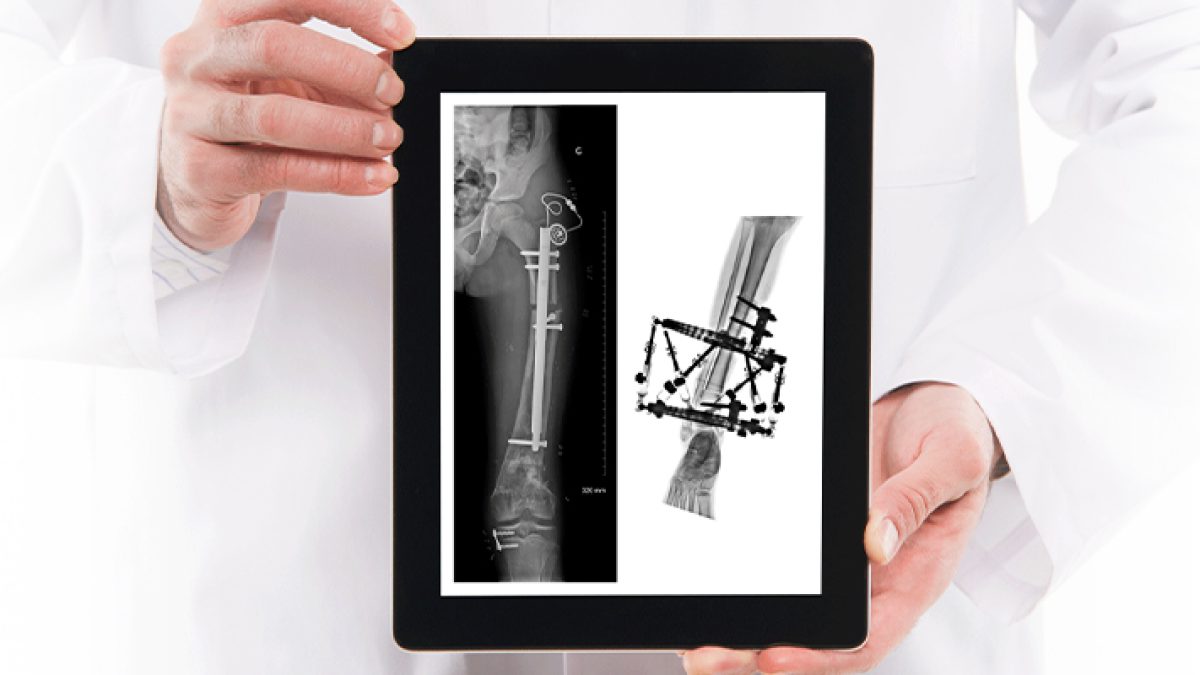 Internal Fixation Device Intramedullary