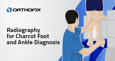 Charcot Foot and Ankle Disease: a quick diagnosis - Orthofix