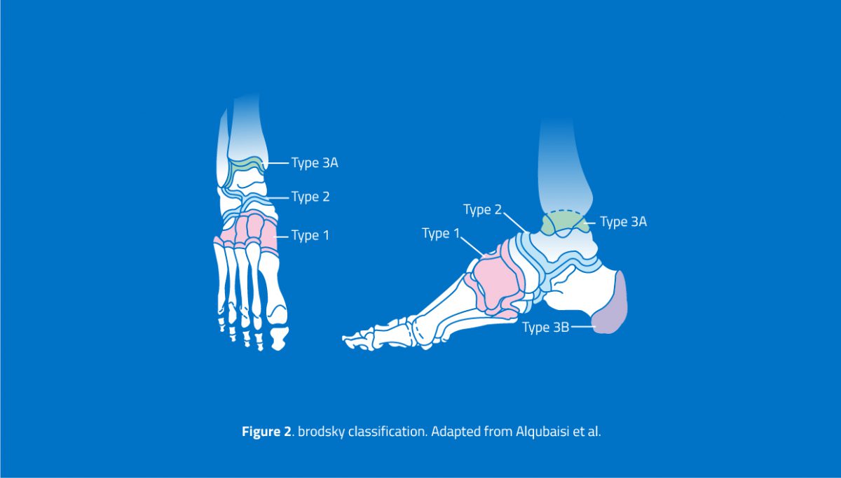 Charcot Foot and Ankle Definition and Classification Orthofix