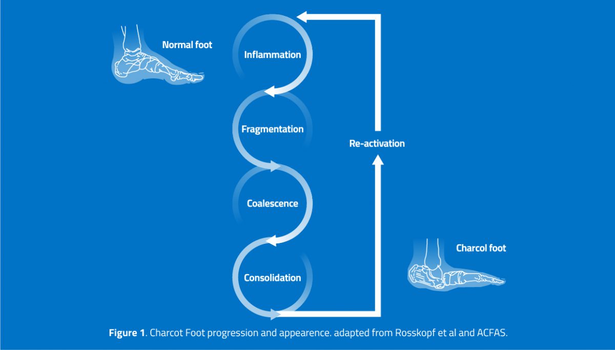 Charcot Foot and Ankle Definition and Classification Orthofix