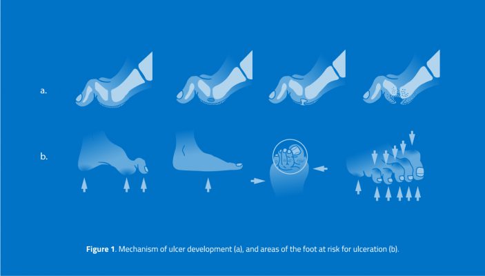 , Charcot Foot and Ankle: Patient Questions and Doctor Answers