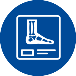 charcot neuropathy, Charcot Neuropathy in the Diabetic Foot
