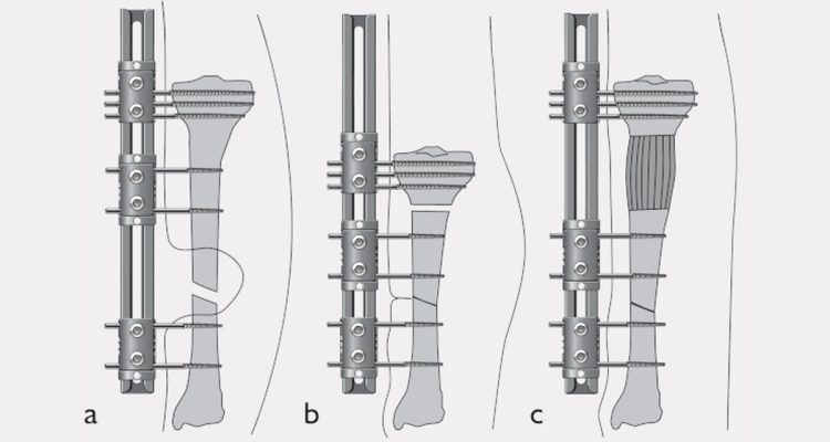 , The Compression-Distraction Technique