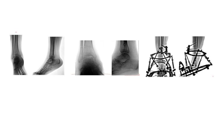 , Acute or Gradual Correction of a Deformity?