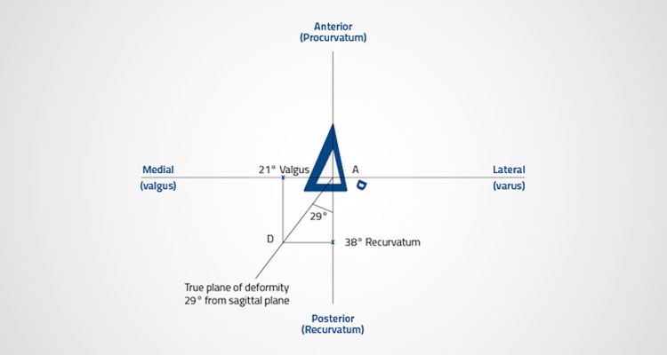 , Calculation of the True Plane of the Deformity