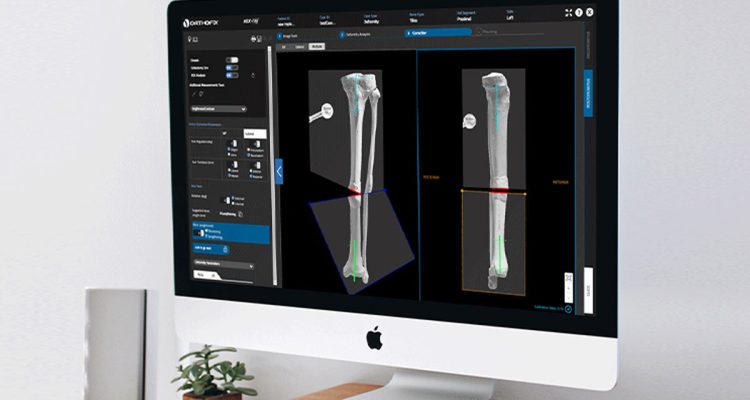 , Principles of Multiplanar Deformity Analysis and Correction in Long Bone