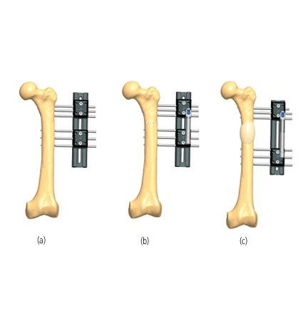 Femur lengthening treatments | Orthofix ABS