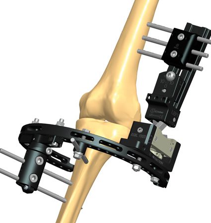 3B28 Knee dislocation