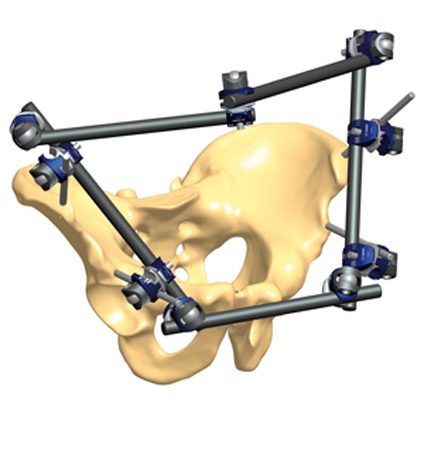 Pediatric recovery of the fractured pelvis | Orthofix ABS