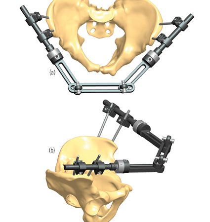 Fractured pelvis recovery | Orthofix ABS