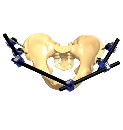 Pediatric recovery of the fractured pelvis | Orthofix ABS