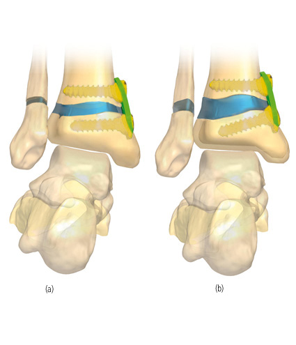 3D14 For Correction Of Deformity - Orthofix