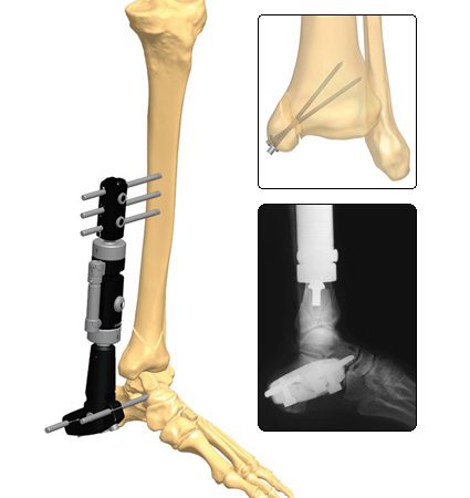 3D5 Fractures