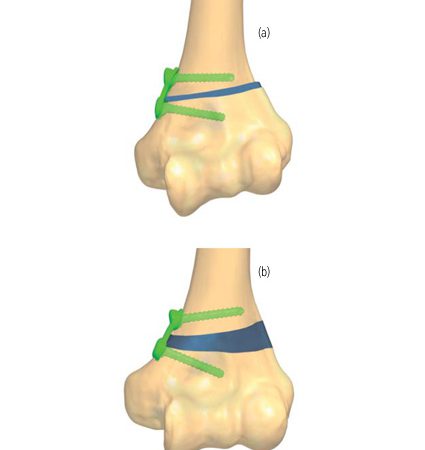Boutonnière Deformity - OrthoInfo - AAOS