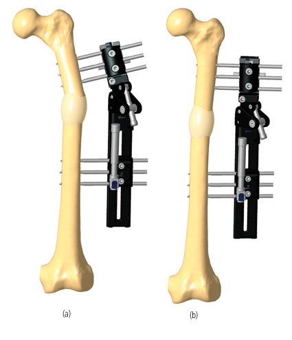 Tibia Lengthening and Deformity Correction With a Multiplanar External  Fixator