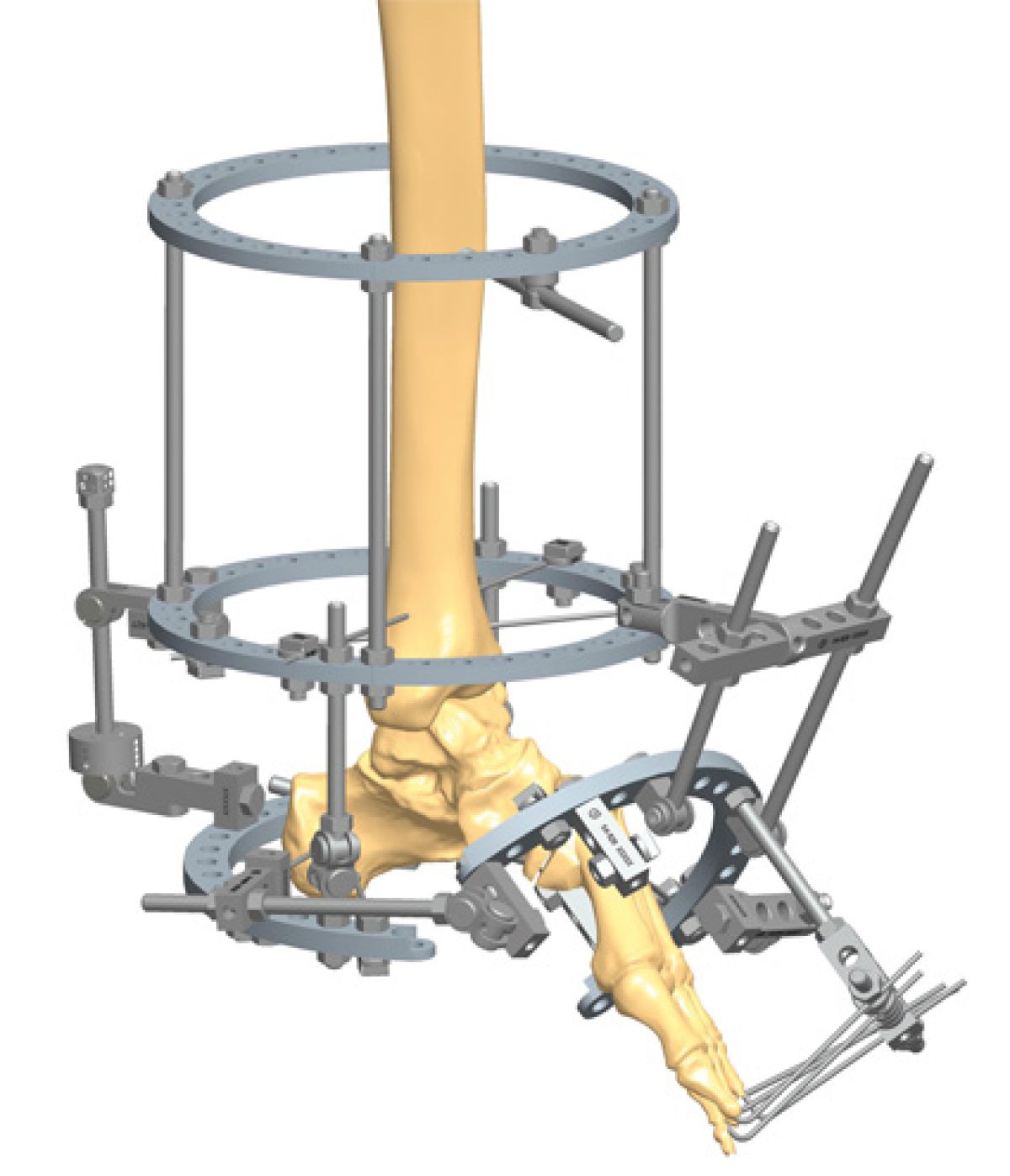 Tibia Ring Ilizarov External Fixation for Clubfoot Treatment - China  External Fixator, Ilizarov External Fixator