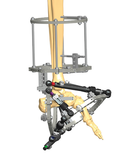 TL-HEX TrueLok Hexapod System - Orthofix