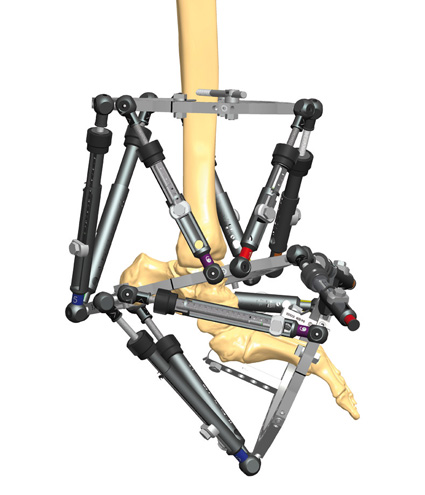 TL-HEX TrueLok Hexapod System - Orthofix