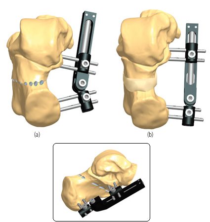 Foot Deformity Correction | Orthofix ABS