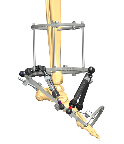 TL-HEX TrueLok Hexapod System - Orthofix