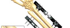 1C4 Fractures