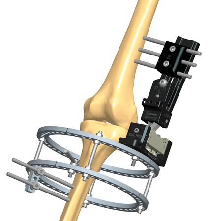3B29 Knee dislocation