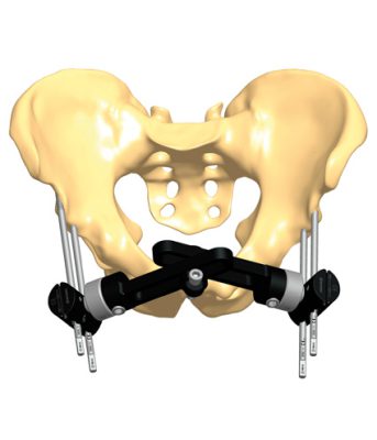 2A4 for Fractures and disruptions - Orthofix