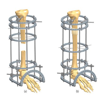 3C53 Bone loss