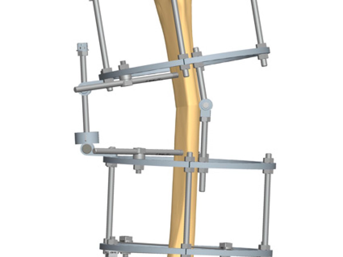 Tibia Lengthening and Deformity Correction With a Multiplanar External  Fixator