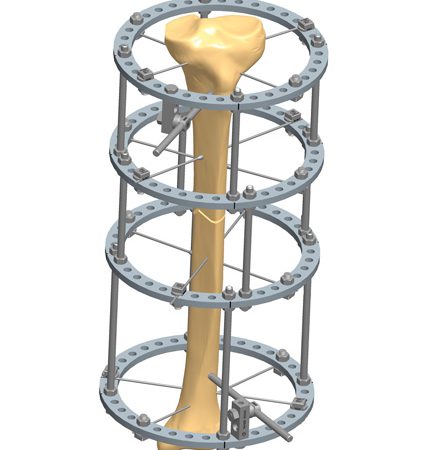 3C10 Fractures