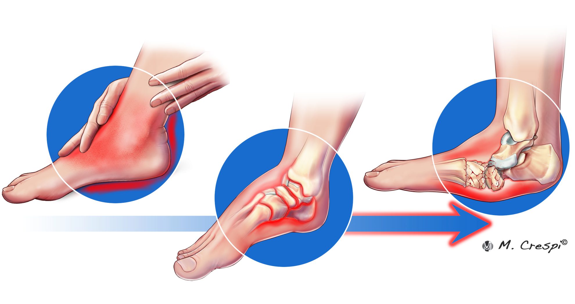 Foot and Ankle Charcot Reconstruction with External Fixation - Orthofix