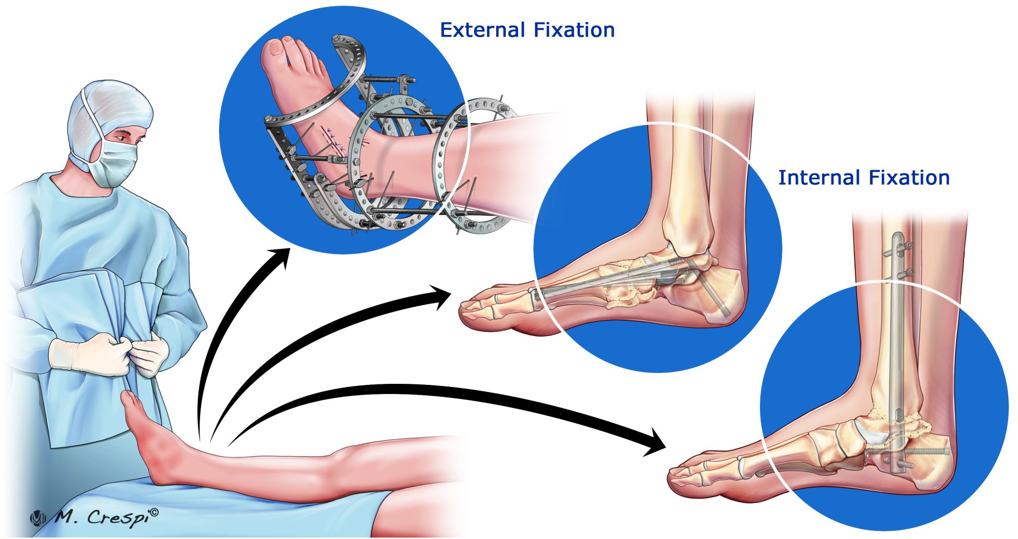 Surgical Approaches for Charcot Foot Orthofix