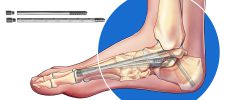 , Charcot Foot Reconstruction Using Internal Fixation