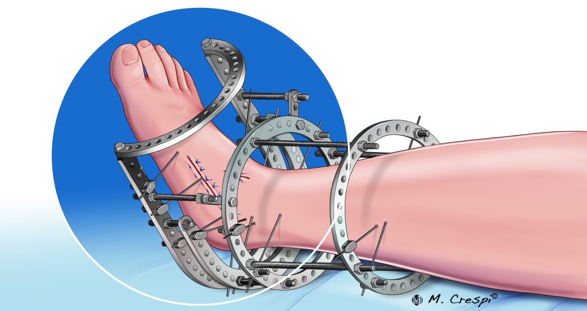 , Foot and Ankle Charcot Reconstruction with External Fixation