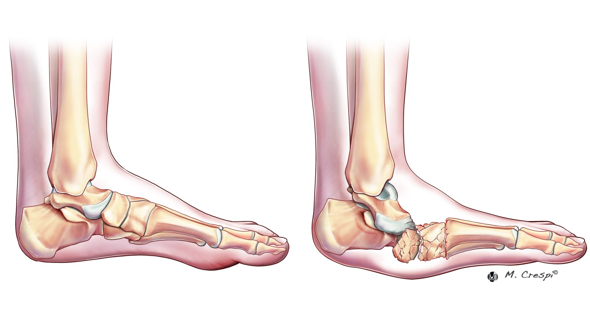 Surgical Approaches for Charcot Foot - Orthofix