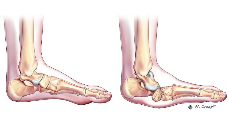 , Surgical Approaches for Charcot Foot