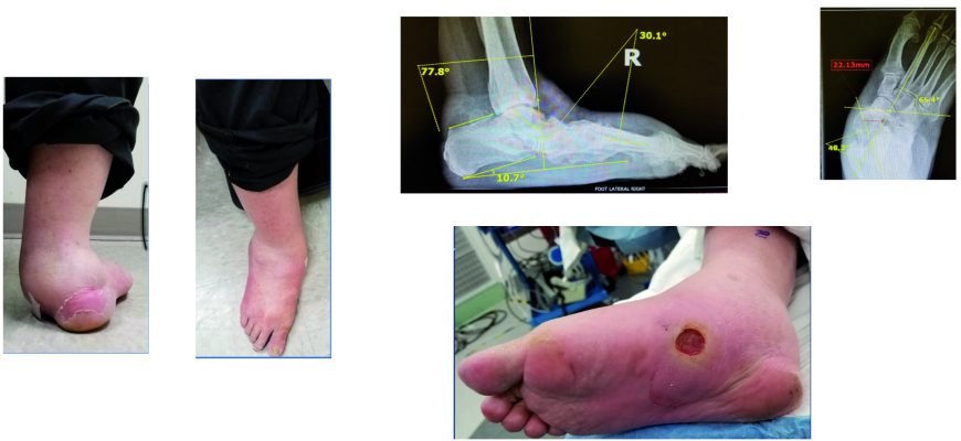 , Foot and Ankle Charcot Reconstruction with External Fixation