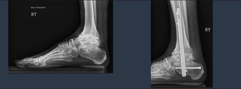 , Surgical Management of the Charcot Ankle
