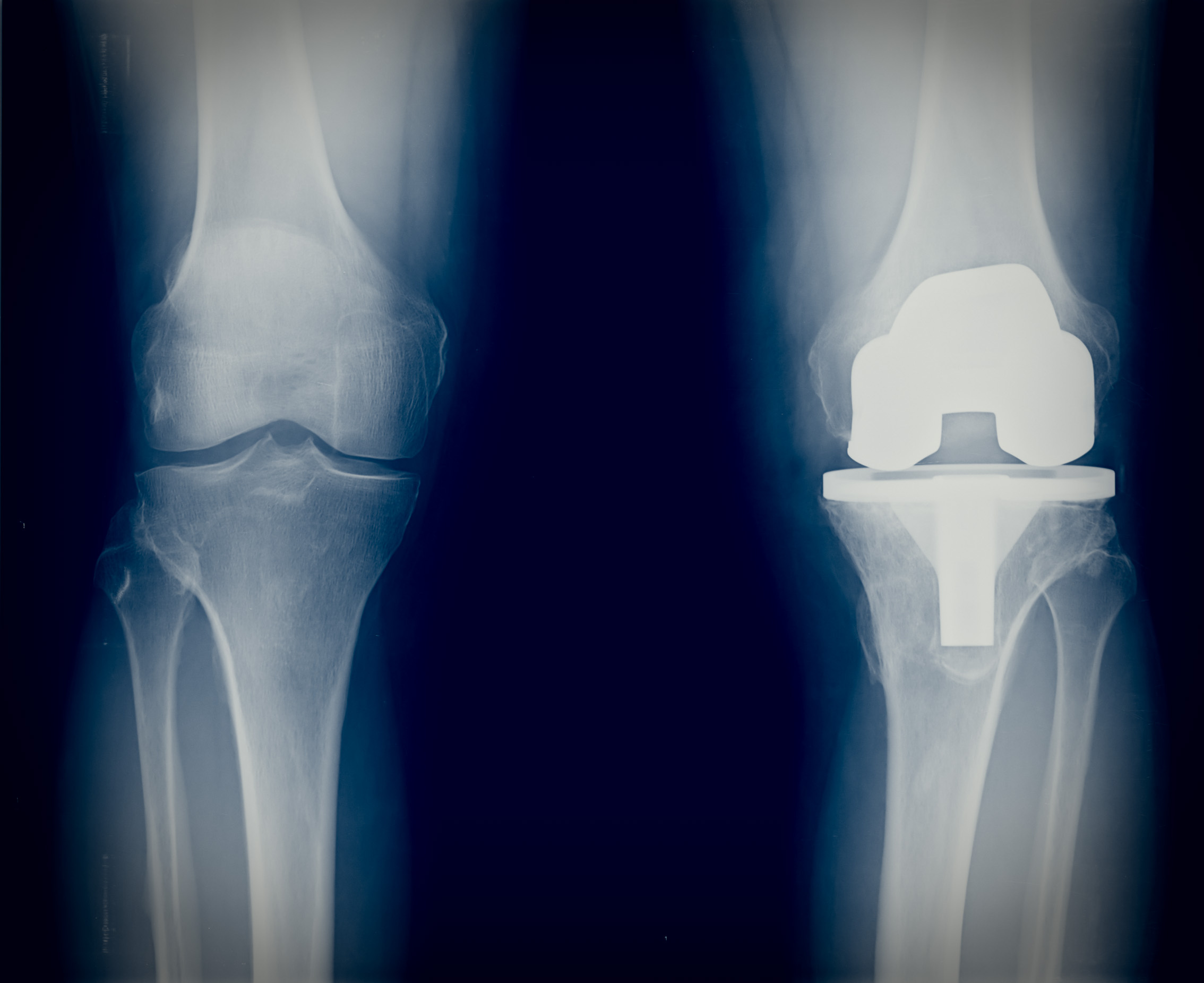 The Challenges Associated with Revision Arthroplasty - Orthofix