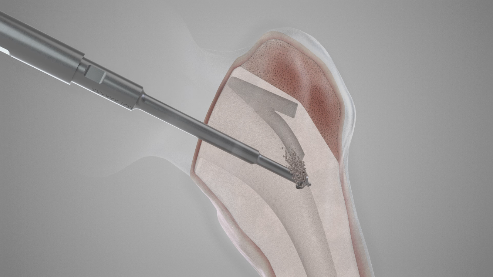 Ultrasound and the Removal of Bone Cement in Revision Arthroplasty